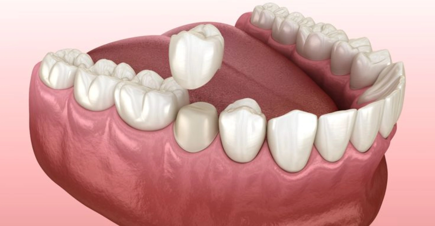 Temporary Crowns1